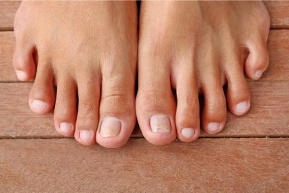ongles des pieds jaunes