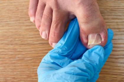 soigner un ongle incarné naturellement